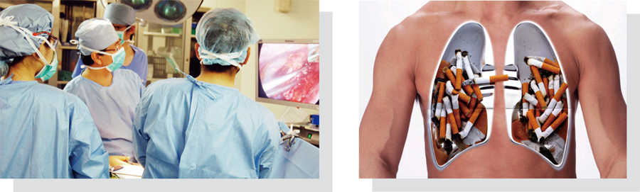 左：手術のようす　右：喫煙者の肺のイメージ